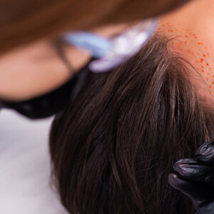 Post-Operative Care: Essential Tips for Hair Transplant UK Patients